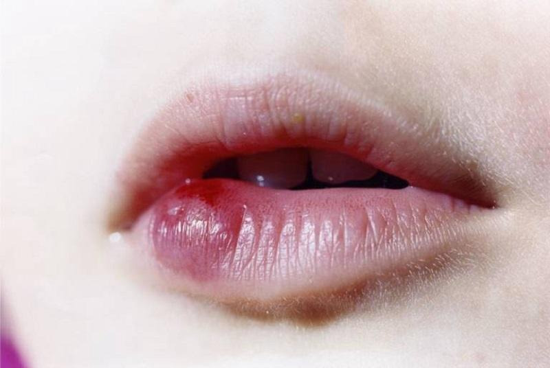Dấu hiệu của phun môi bị nhiễm trùng